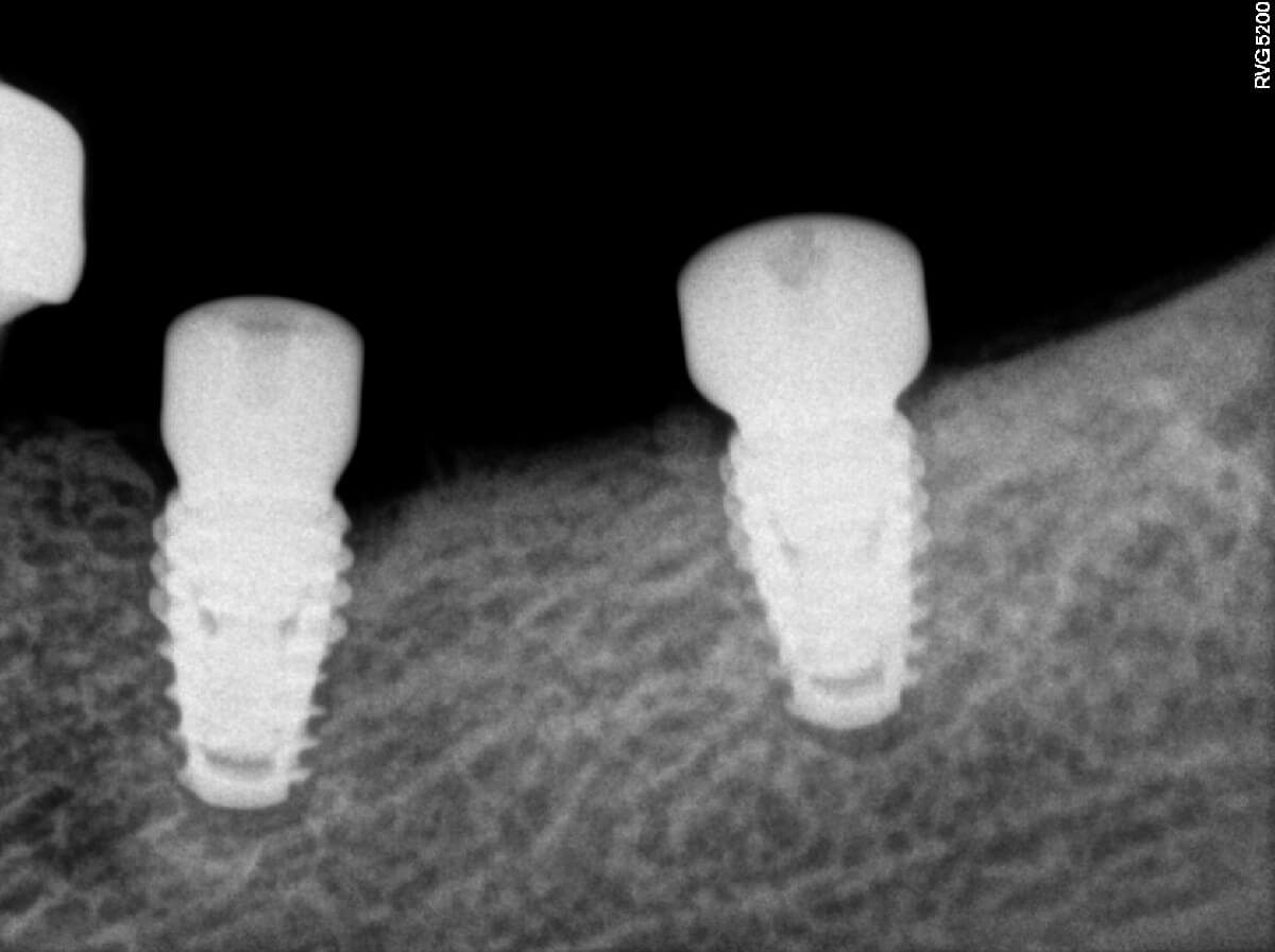 Natural Tooth V/s Dental Implant
