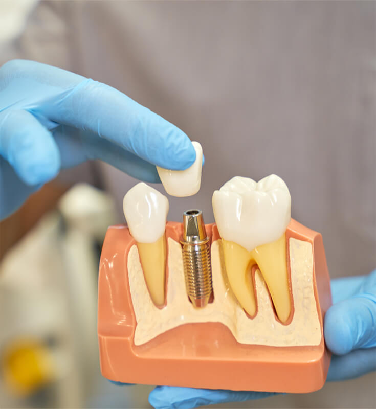 Dental Implants Treatment in Malad West