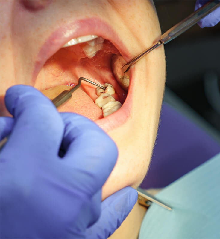 Wisdom tooth removal Treatment in Malad West