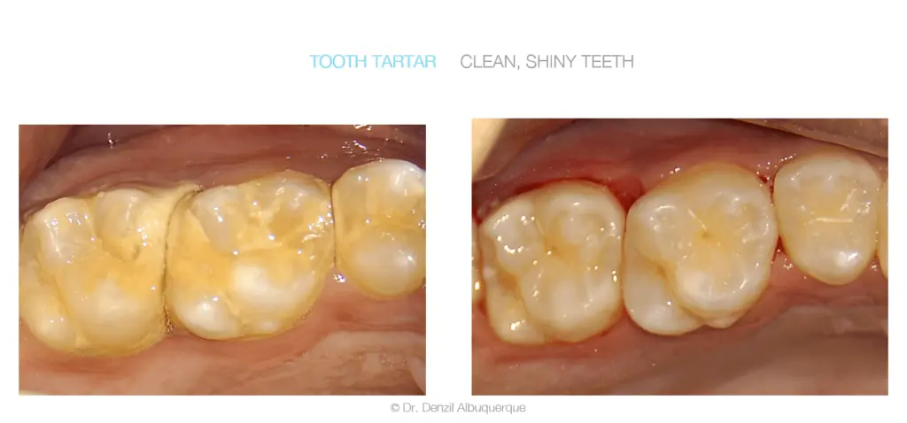 Clean Shiny Teeth