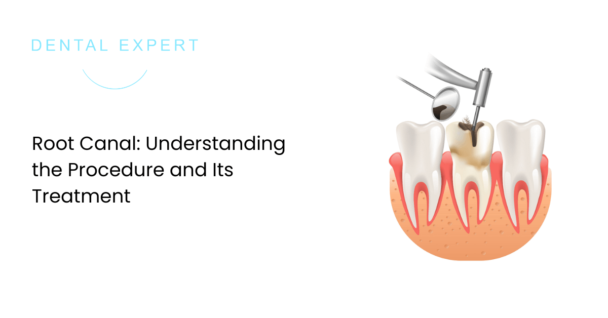 Root Canal: Understanding the Procedure and Its Treatment