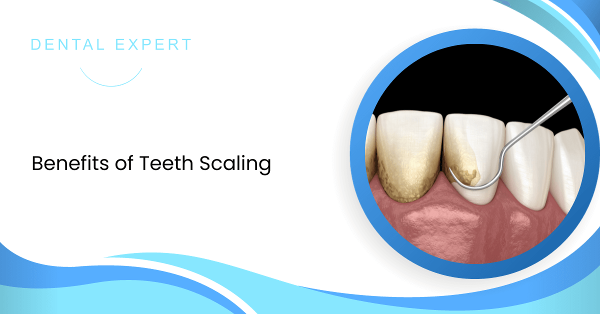 Benefits Of Teeth Scaling