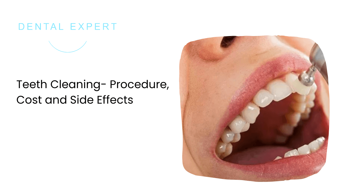 Teeth Cleaning- Procedure, Cost and Side Effects