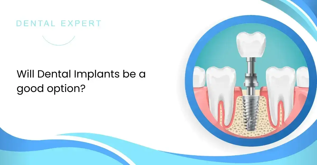 Will Dental Implants be a good option?