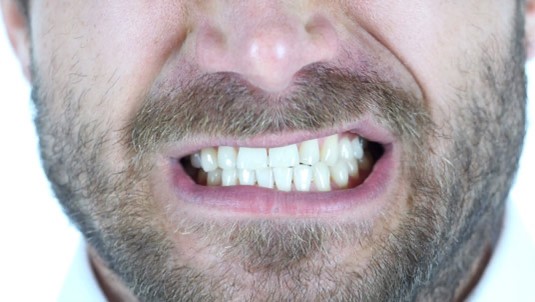 Bruxism -Teeth Grinding