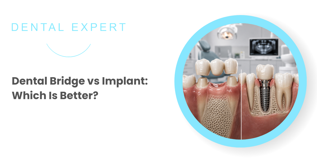 Dental bridge and dental implant comparison for replacing a missing tooth